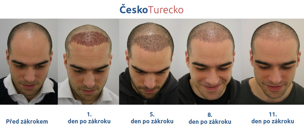 transplantace vlasů v Turecku výsledek diskuze