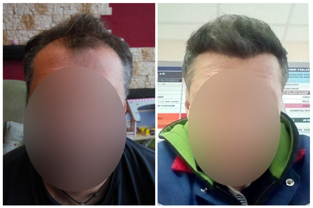 Výsledek transplantace vlasů v Turecku pana Františka