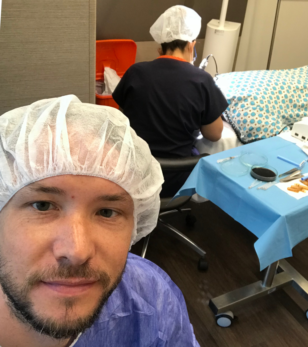 Transplantace vlasů v Turecku aneb od myšlenky až po samotný zákrok 4 Milan Hnátek ČeskoTurecko transplantace vlasů