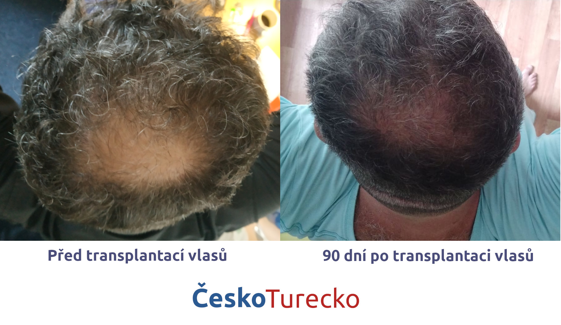 Průběžný výsledek transplantace vlasů - 90 dní