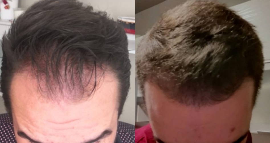 Kdy začnou růst vlasy po transplantaci?