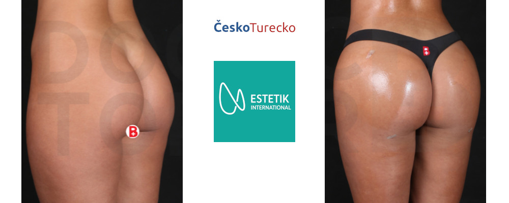 Plastická operace hýždí – Brazilian Butt Lift Turecko
