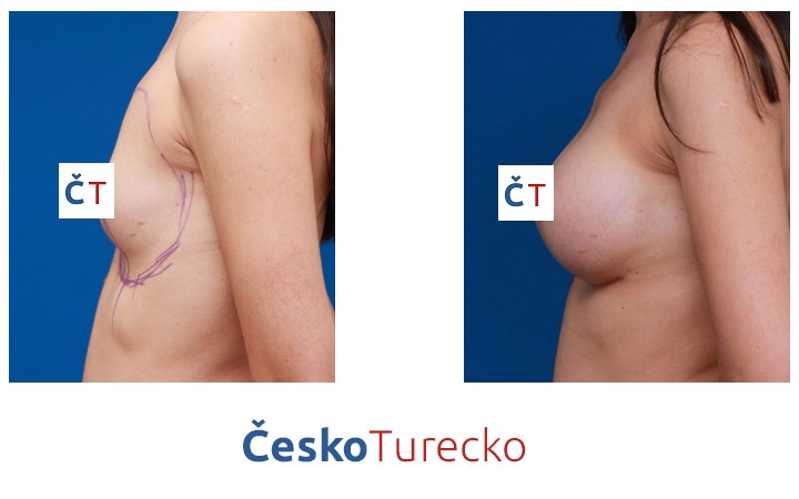 Plastická operace prsou předtím a potom ČeskoTurecko