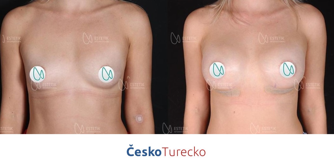 Plastická operace prsou v Turecku zvětšení ňader pomocí augmentace