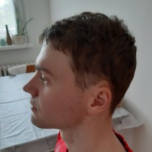 Výsledek transplantace vlasů rok od zákroku