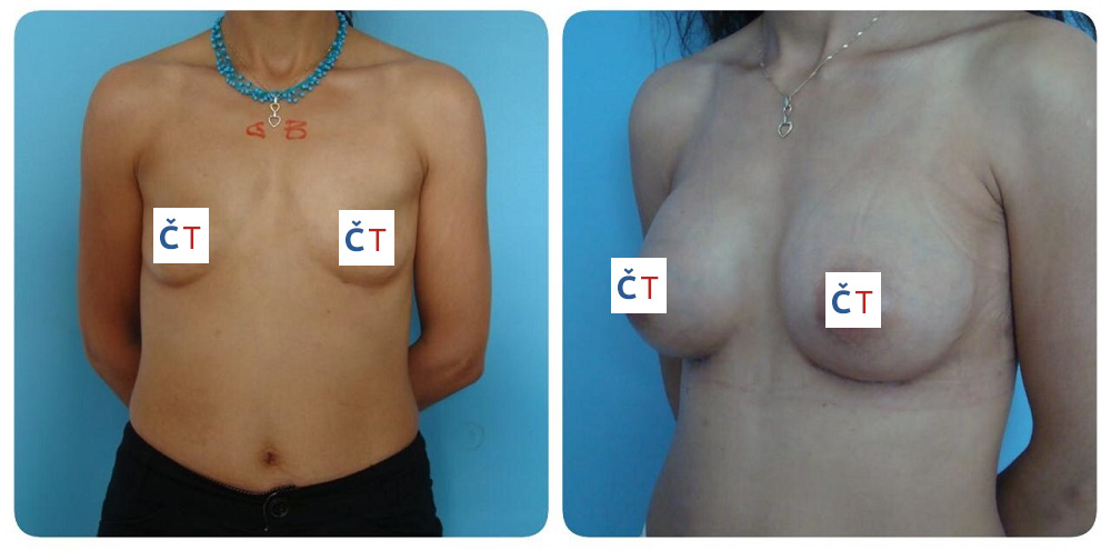 Plastika prsou v Turecku nejsou jen silikony, ale plastická chirurgie nabízí víc! 2 Plastika prsou