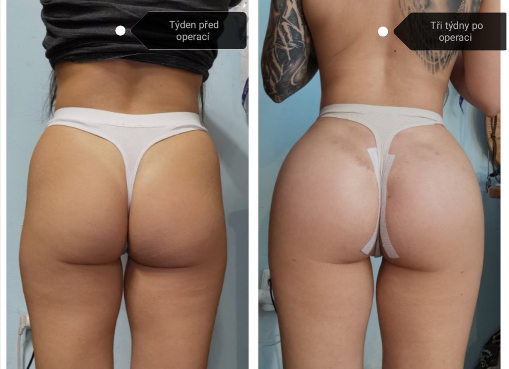 Zkušenost se zvětšením hýždí – Brazilian Butt Lift (BBL) v Turecku