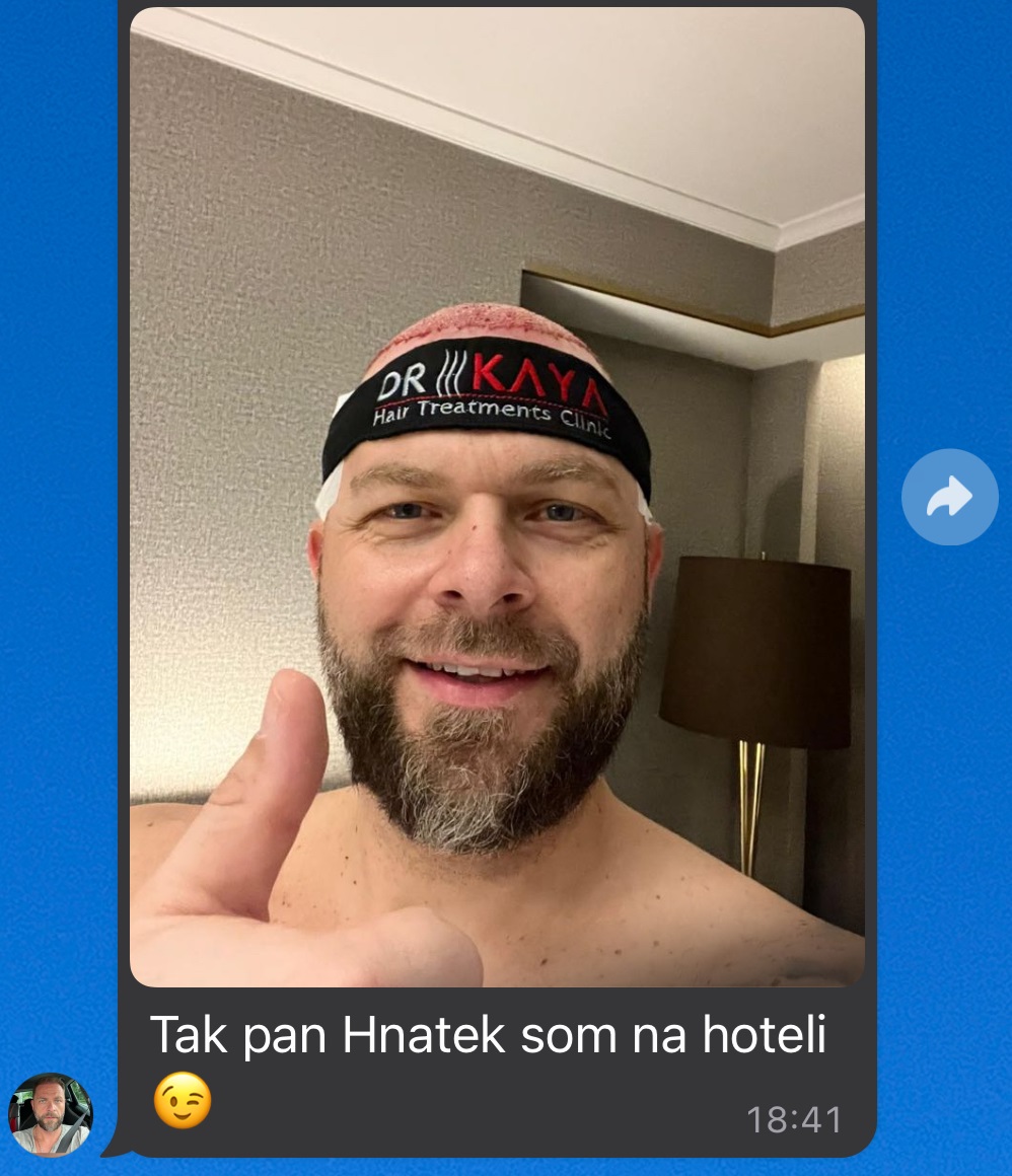 Po transplantaci vlasů v Turecku