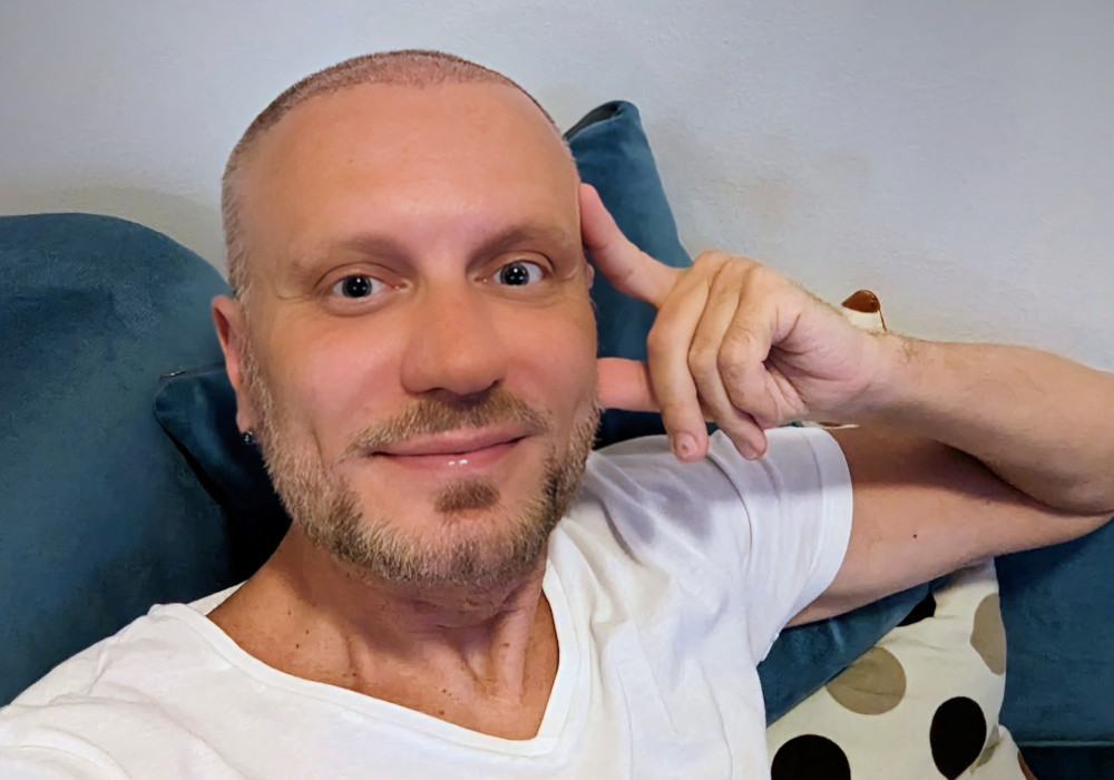 Rok po zákroku: Od pochybností k novým vlasům - příběh pana Jiřího 3 10 dní po transplantaci vlasů v Istanbulu